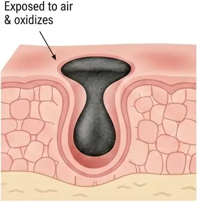 Blackheads (Open Comedones)